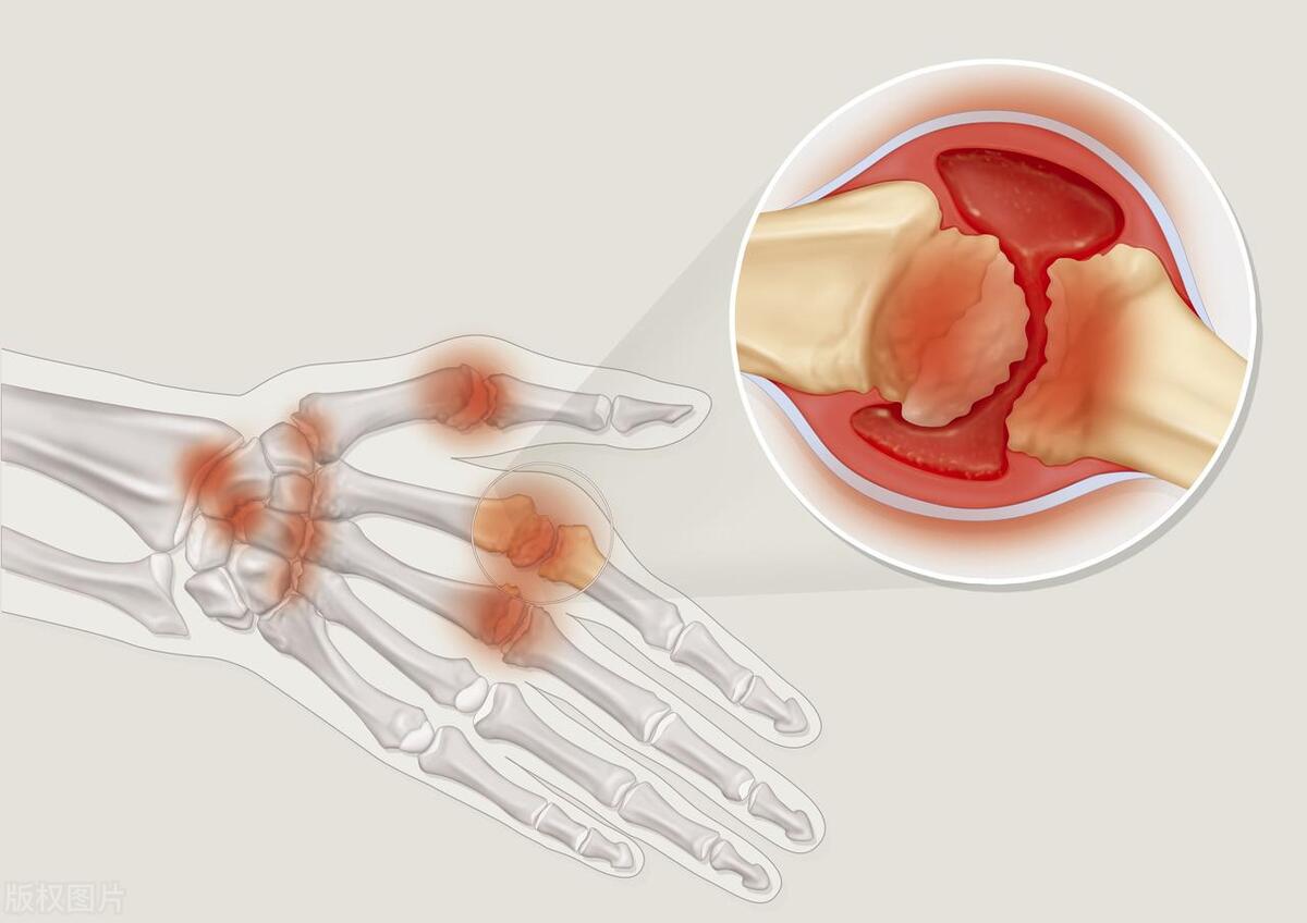 多医院中心开展无偿治疗：类风湿关节炎新药Peresolimab显疗效