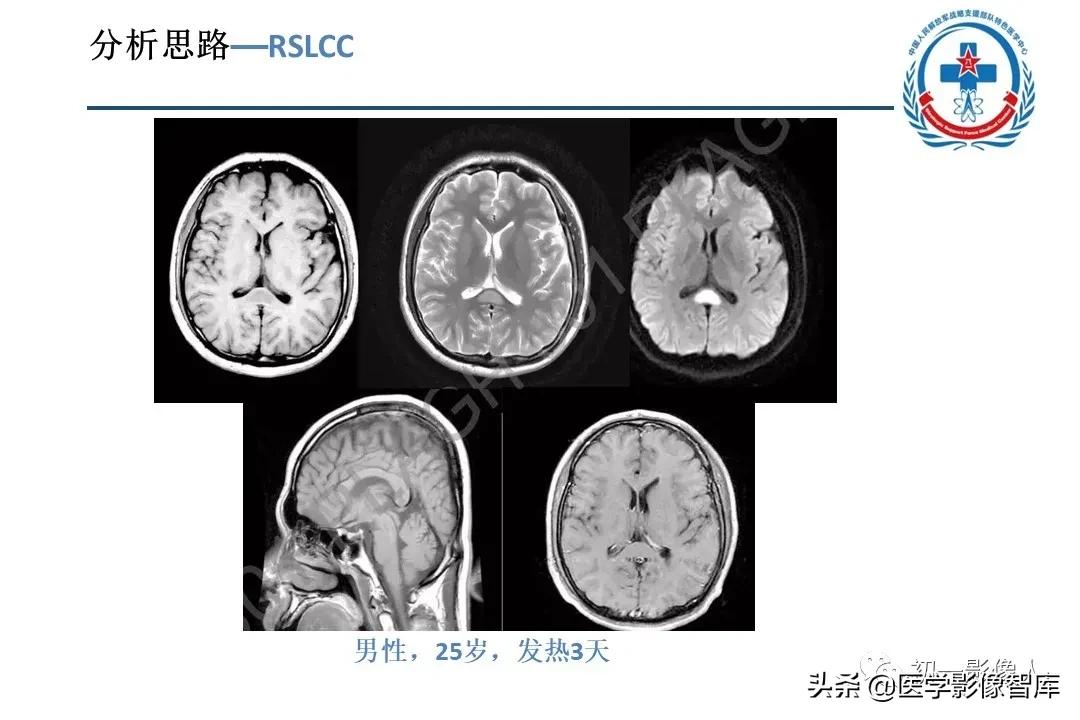 胼胝体变性治疗方法,原发性胼胝体病变治疗