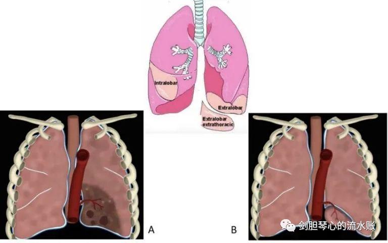 左肺下叶肺隔离症需手术吗,左肺下叶肺隔离症是什么意思