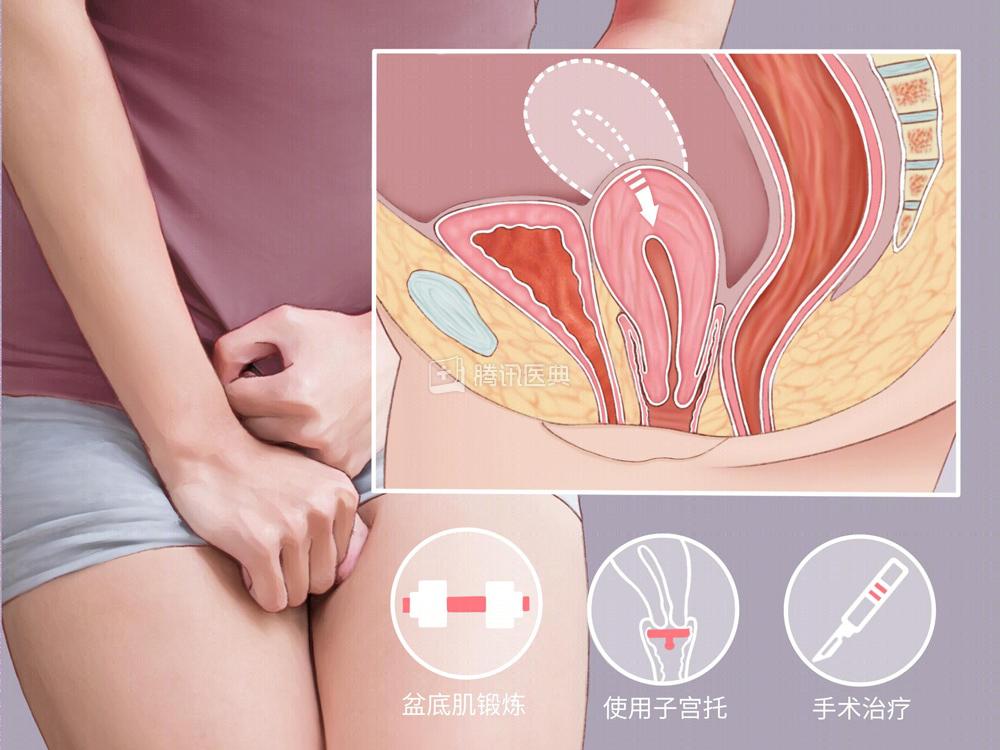 “医生，我觉得有东西从阴道掉下来……”