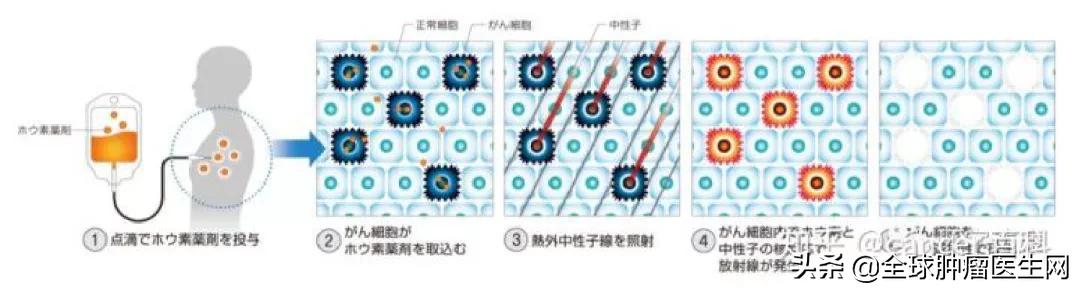 硼中子俘获治疗国内最新进展,国内首台硼中子俘获治疗装置下线