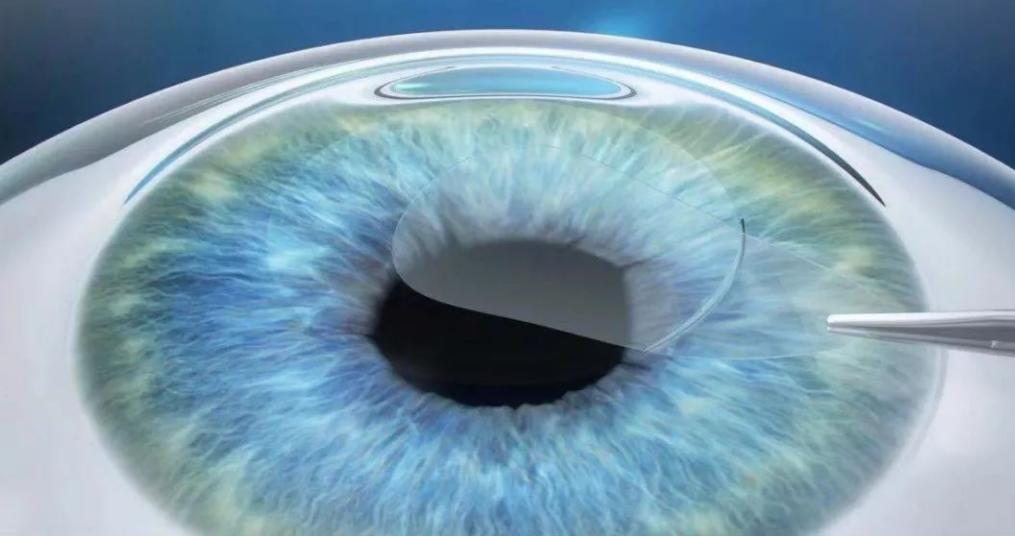 全飞秒手术告别眼镜拥抱自由视界,全飞秒手术锻炼眼睛