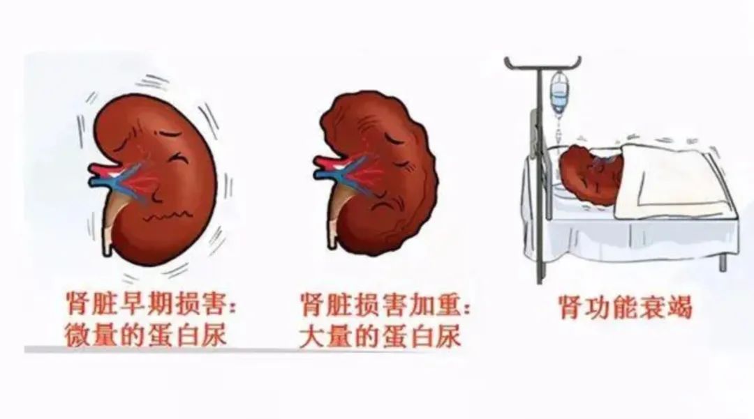 急性肾绞痛是几级,急性肾绞痛吃什么药止痛