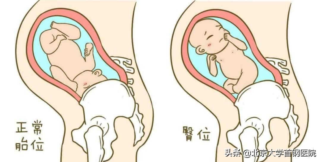 90后宝妈历险记：臀位宝宝也能顺产？！医患齐心实现“华丽转身”