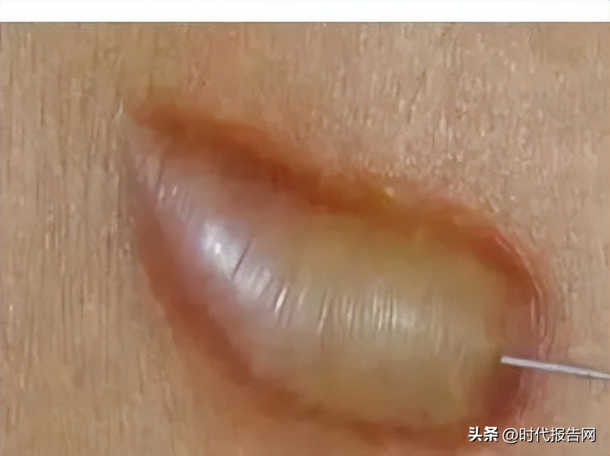 健康科普急救,瘢痕软化针配比及注射过程