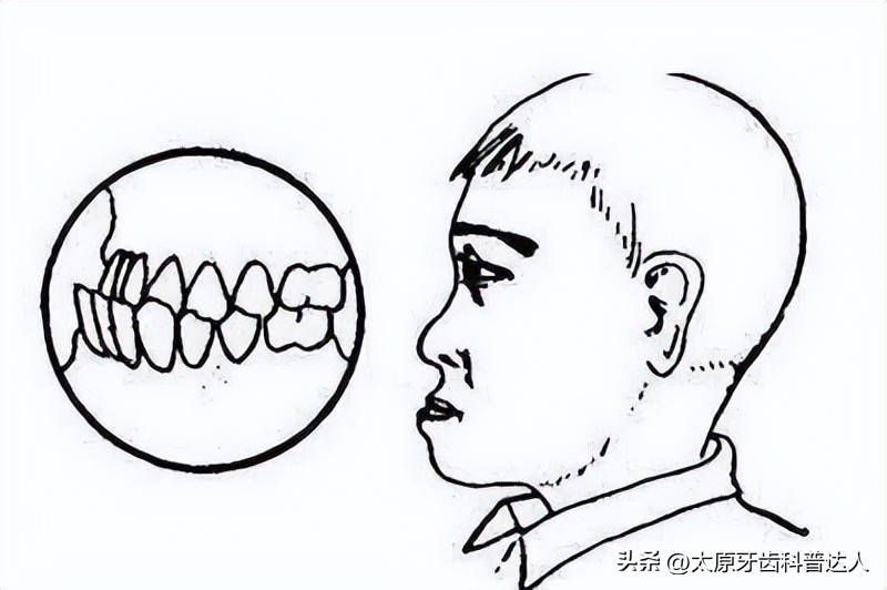 儿童地包天治疗过程,什么是地包天治疗