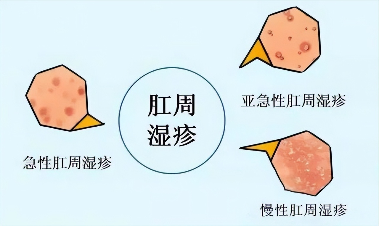 肛周癌与肛门瘙痒的区别,肛周长期瘙痒是有癌症吗