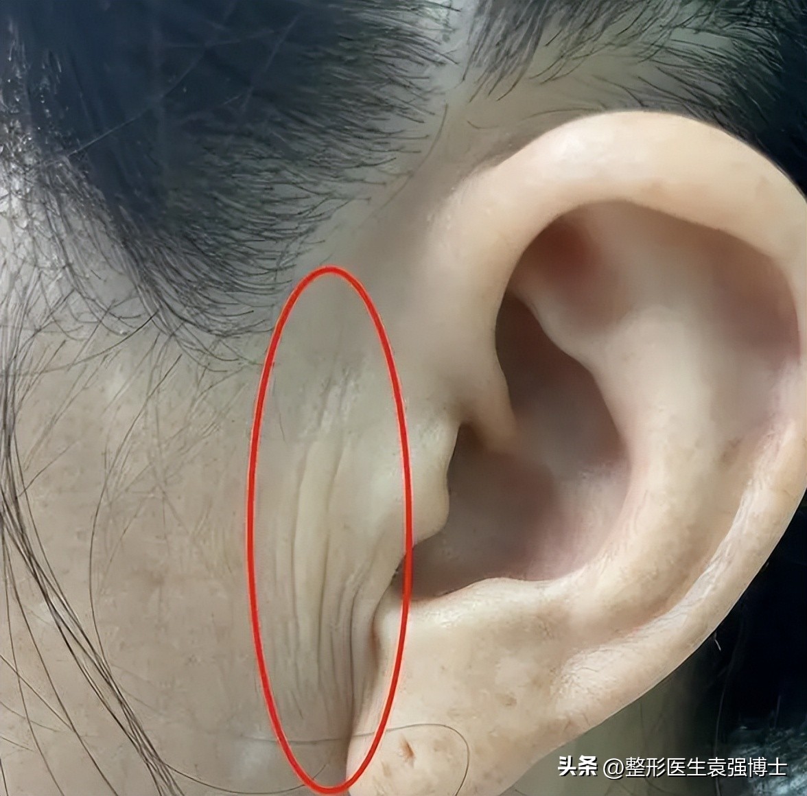 做拉皮手术会越来越薄吗,拉皮手术危险有真相