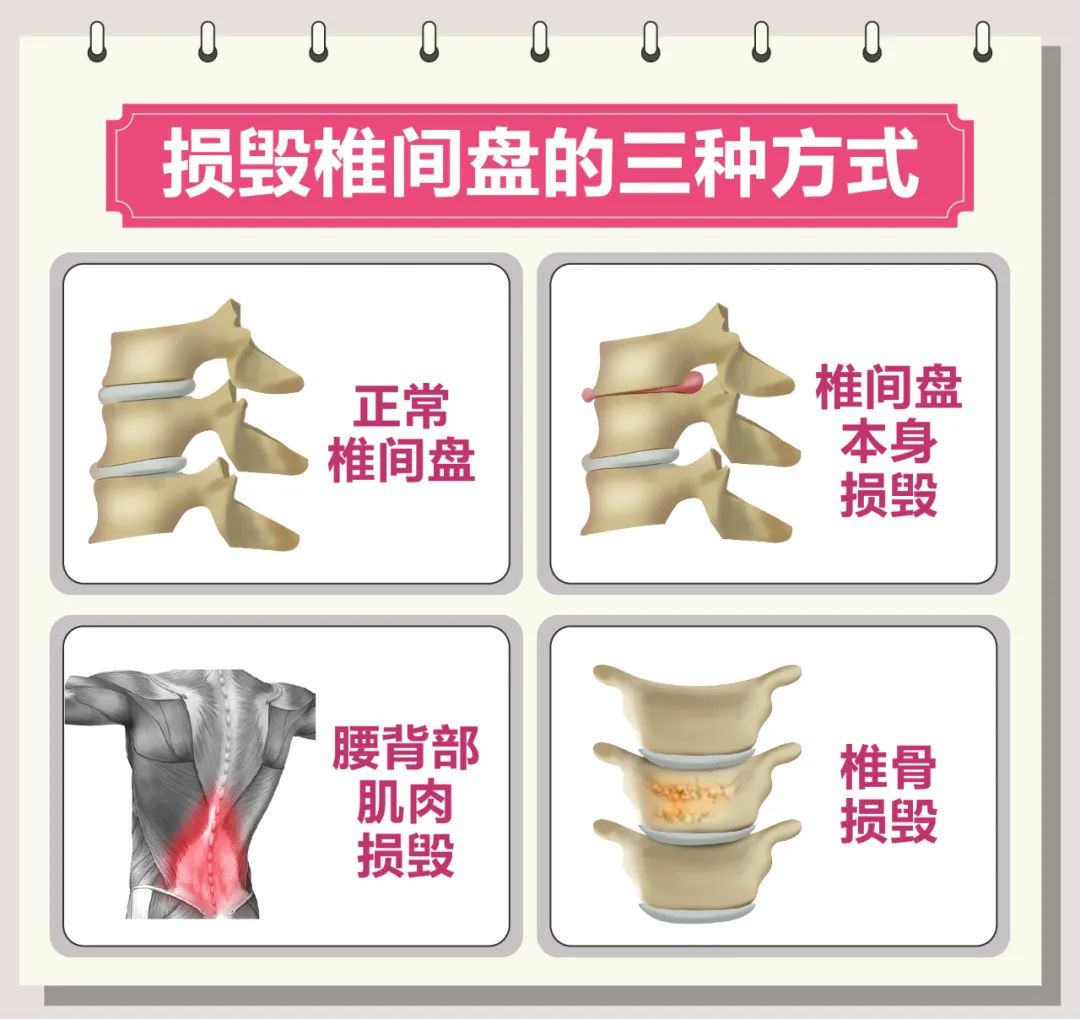 脊柱病三个动作自愈方法,椎间盘突出可以做脊柱屈的动作吗
