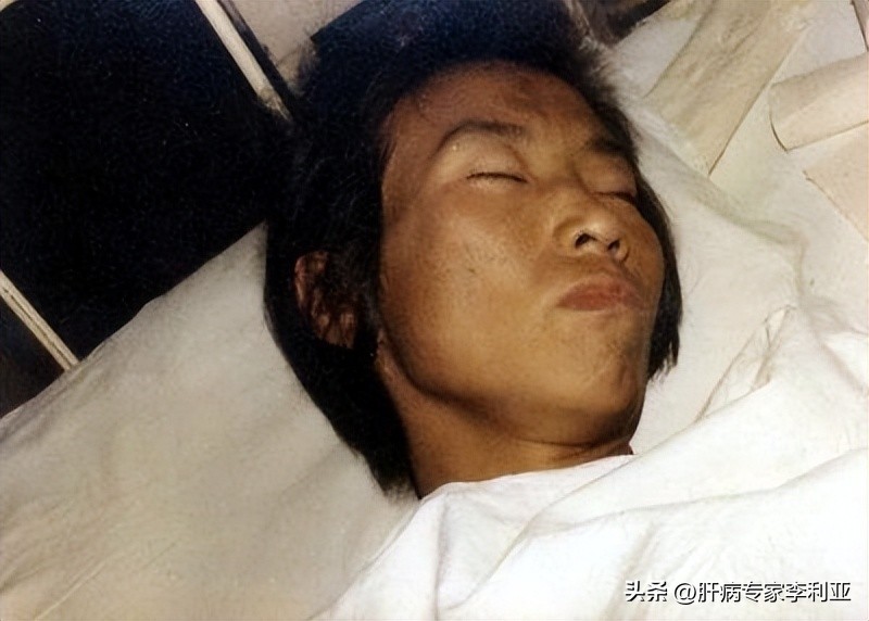 肝癌征兆身上长痘吗,肝癌脸上长痘痘怎么回事