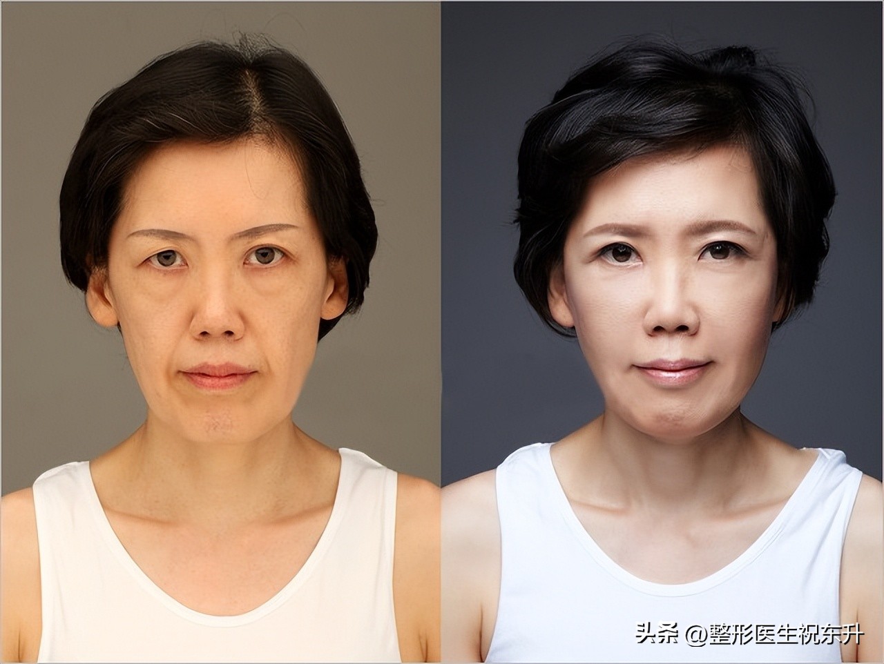 面部年轻化项目,面部年轻化案例