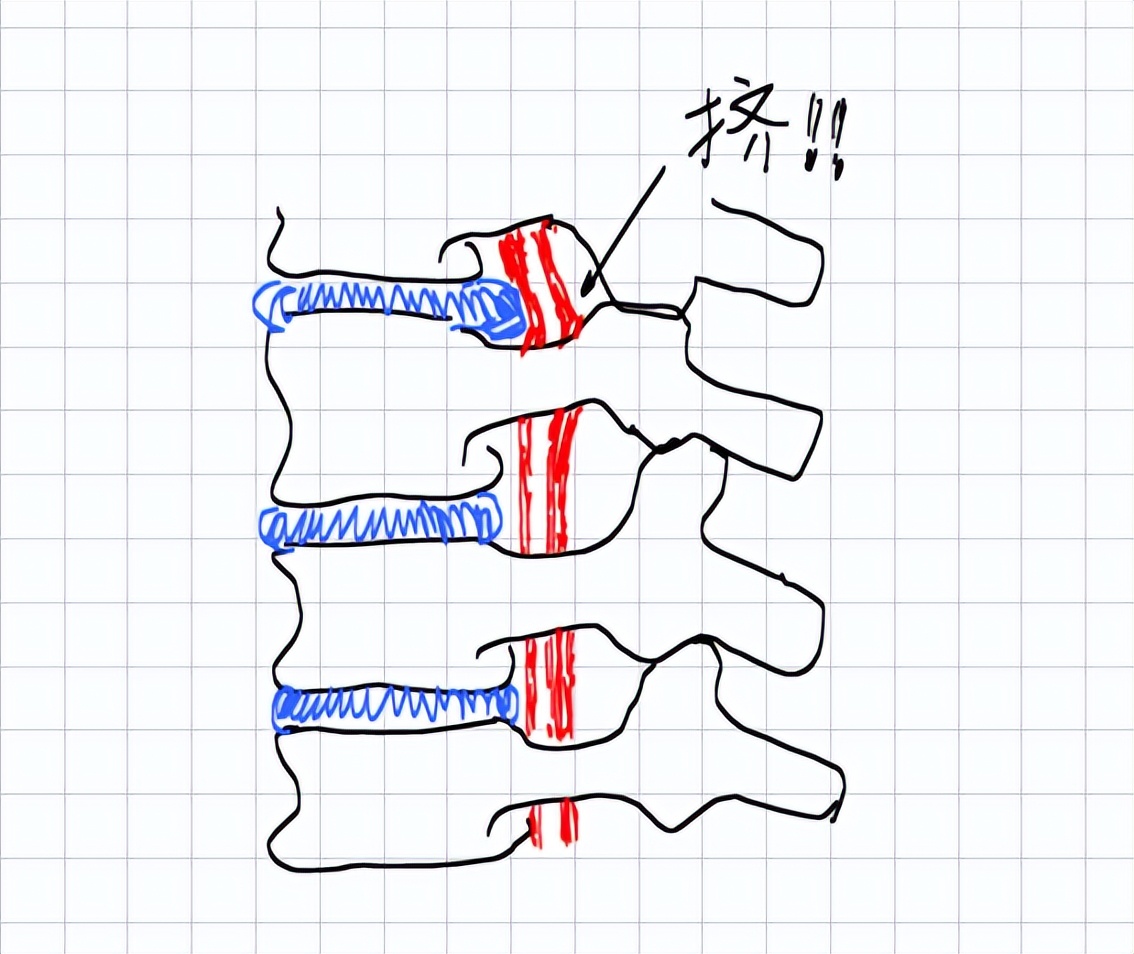 「诺总侦破日记」低头族颈椎失效模式的技术分析
