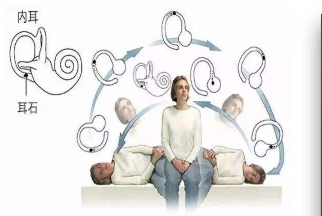 医生怀疑是耳石症,感觉自己是耳石症医生却说不是