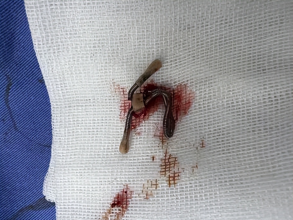 【科普】杭州一女士子宫里嵌进“钩子”，家有女性长辈注意！