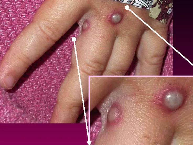 猴痘开始在西班牙蔓延感染方式诡异欧洲各国开始考虑买疫苗