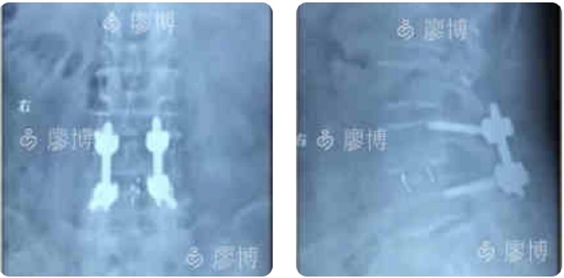 olif治疗腰椎滑脱有效吗,olif腰椎融合手术国内哪里做的好