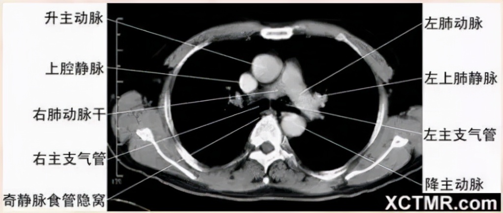 胸腹部盆腔ct主要检查什么,女性盆腔ct断层解剖结构图