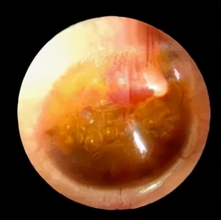 分泌性中耳炎引起的传导性耳聋,儿童急性分泌性中耳炎会致耳聋吗