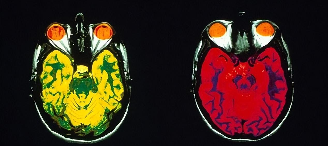 这种血型竟是老年痴呆的天生克星,哪种血型人容易得老年痴呆