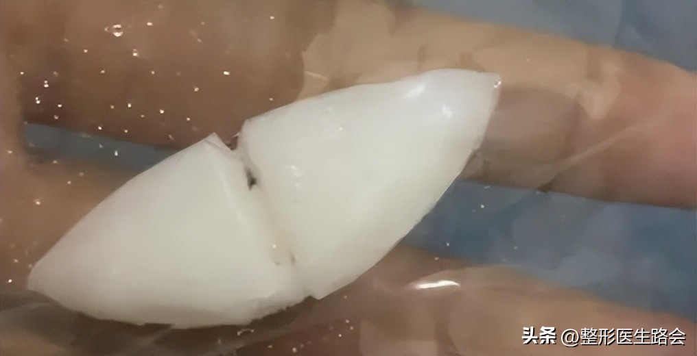 做假体下巴后的真实感受,做了假体下巴很后悔