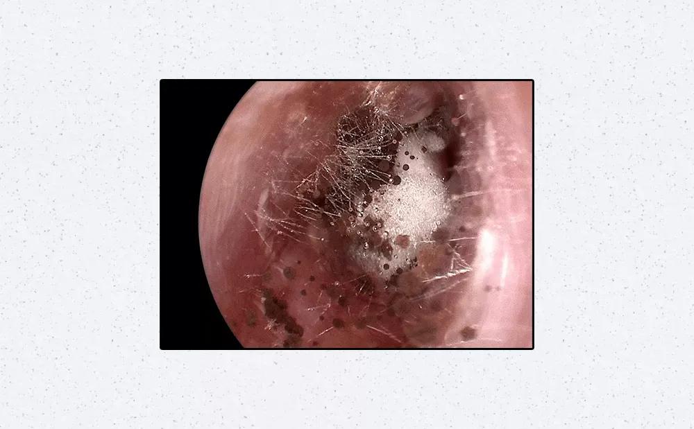 总是抠耳洞很痒怎么办,刚打的耳洞痒痒老想抠怎么办