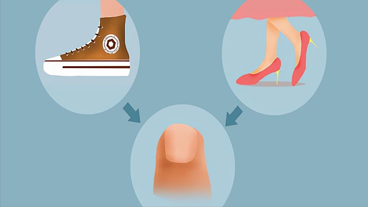 脚趾甲往肉里钻怎么治疗,脚趾甲老往肉里面长怎么办