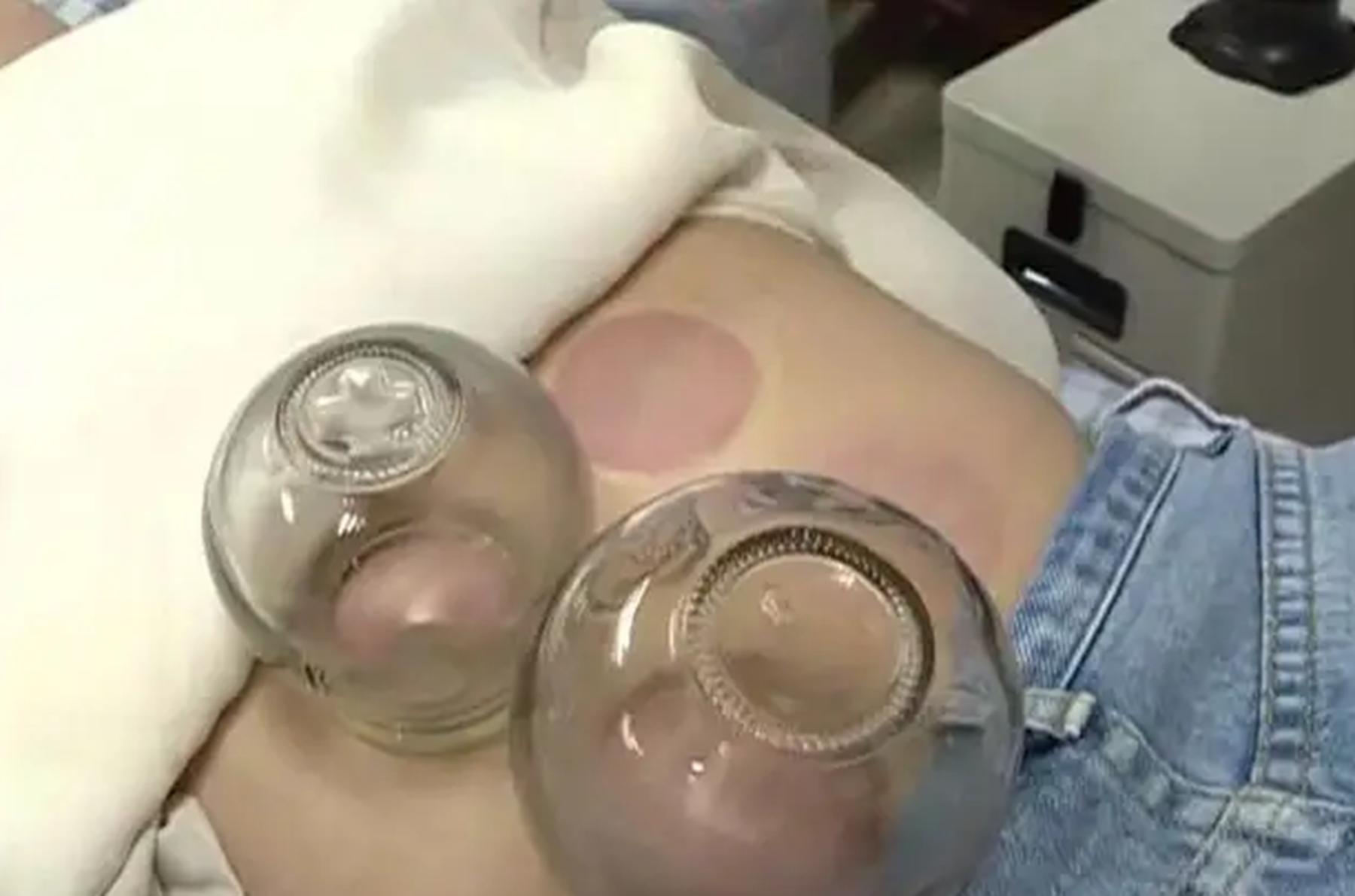 女子拔罐二度烧伤后续,女子拔火罐被烧伤后续