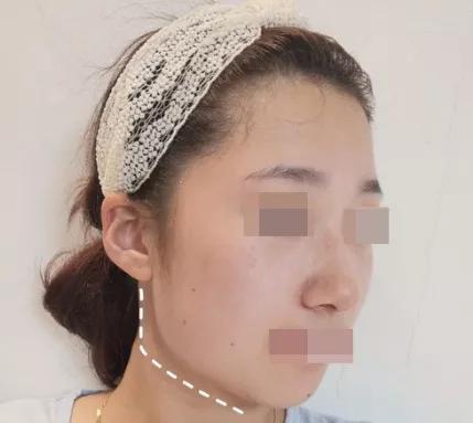 怎么确定是咬肌还是下颌角,怎么判断下颌角肥大还是咬肌大