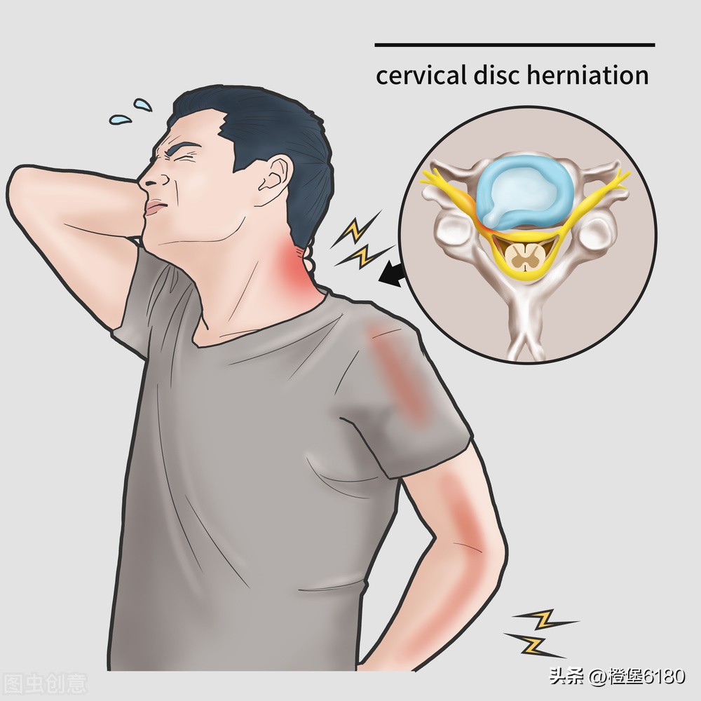 颈椎病导致的手臂酸软无力怎么办,神经根型颈椎病手臂酸胀麻怎么办