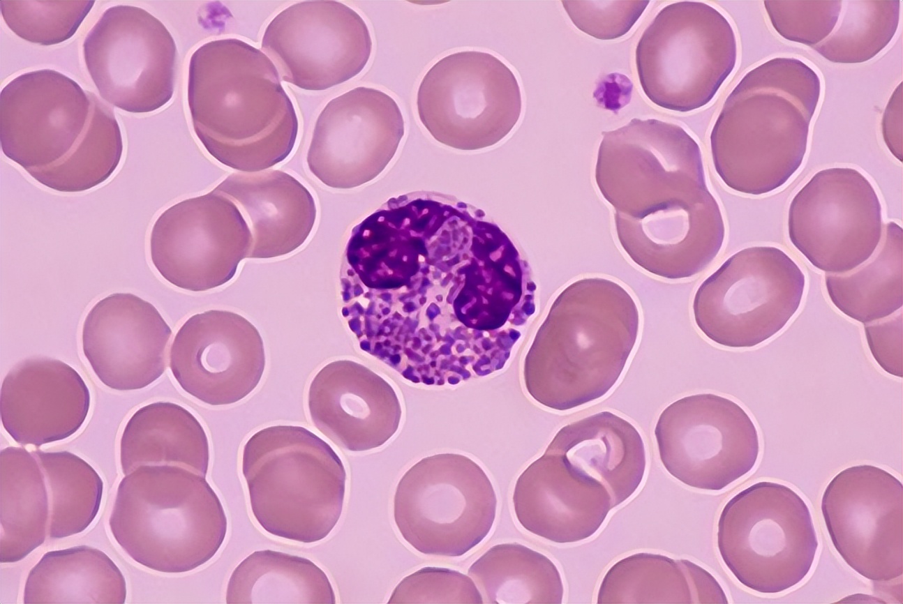 血常规哪些项目异常要警惕,血常规这几项异常一定要引起重视