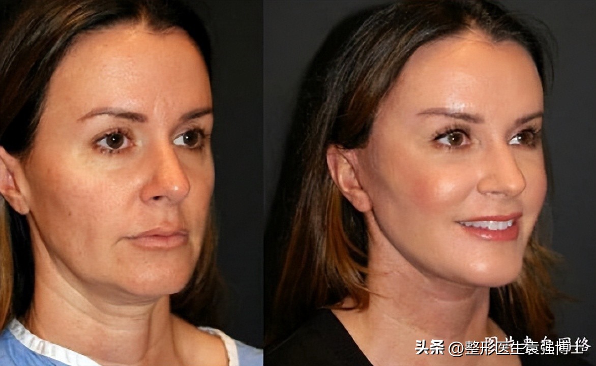 55岁后适合做拉皮手术吗,60岁适合做拉皮手术吗