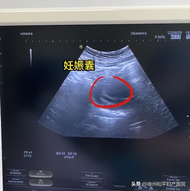 二胎药流后丈夫舍不得花钱治！女子流产大出血冒寒风上医院