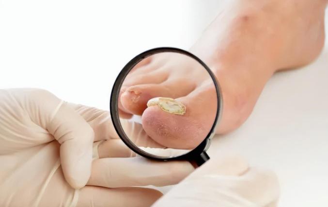 脚趾甲老往肉里钻，一碰还疼？教你小妙招，预防甲沟炎告别疼痛
