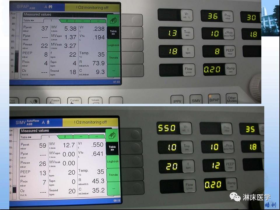 机械通气患者气道管理ppt,机械通气基础知识ppt