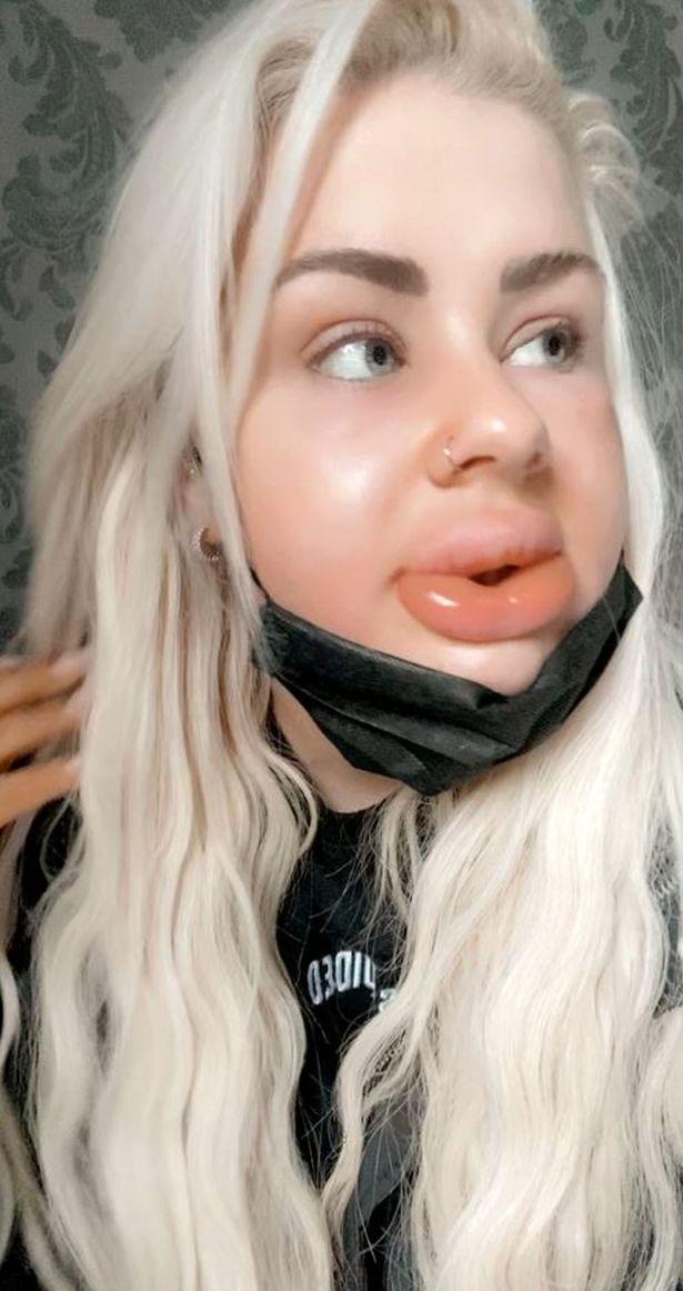 丰唇失败变成香肠嘴,丰唇手术后变成香肠嘴