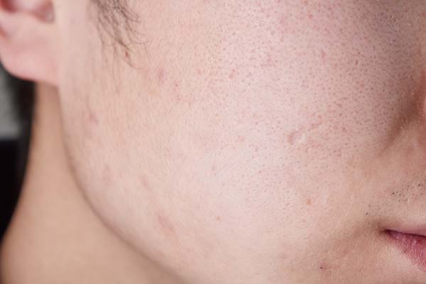 雄性激素越高越好吗,雄性激素过高有什么危害