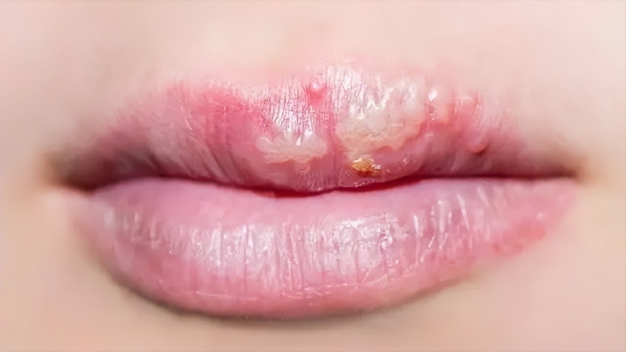 嘴巴周围有好多小水泡是上火吗,嘴上上火长水泡会传染吗