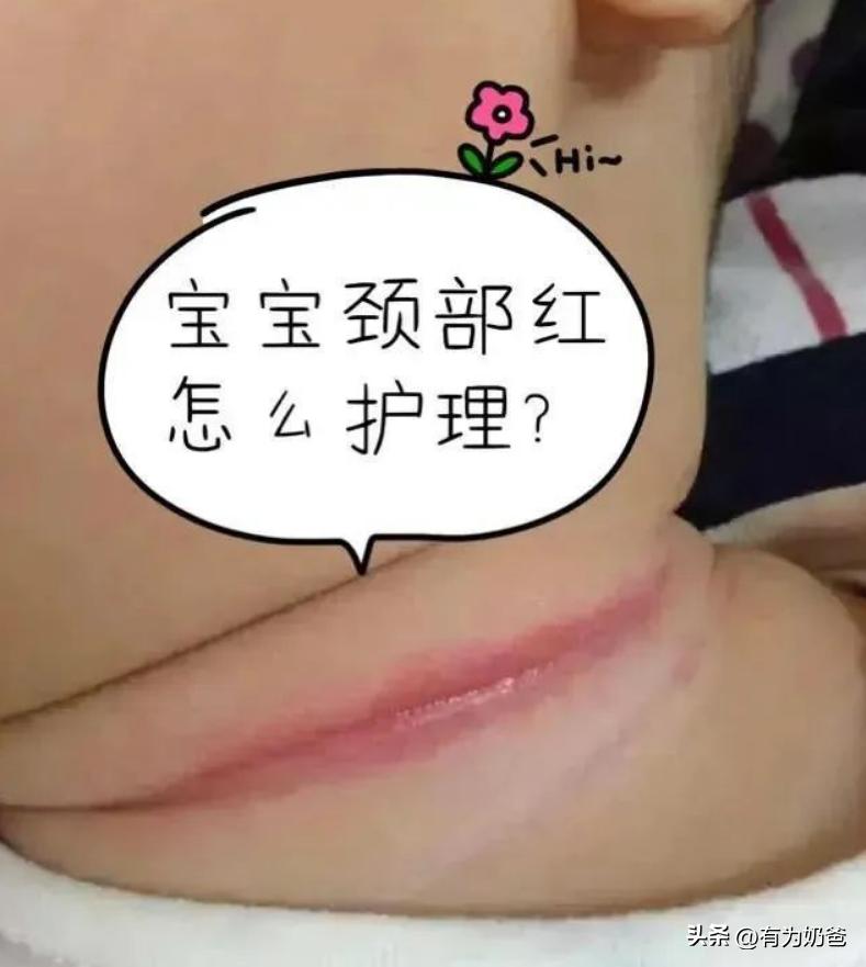 宝宝淹脖子红斑,宝宝淹脖子还起干皮