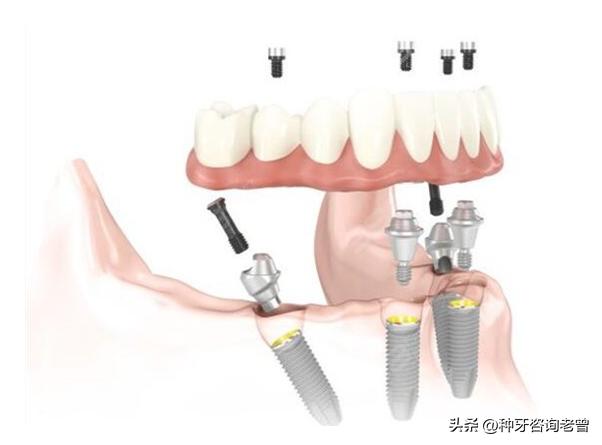 做了种植牙后的真实感受,种植过牙的人亲身经历