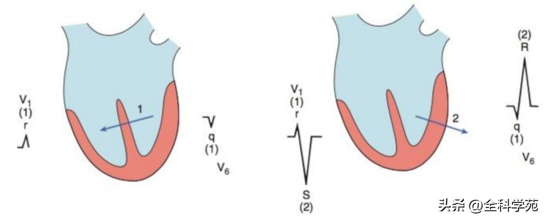 心电图qrs间期变长是怎样造成的,心电图qrs振幅多少是正常范围
