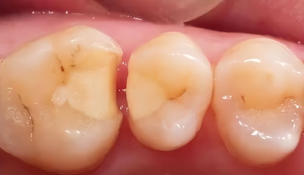 牙齿掉了一块怎么办？需要拔牙吗？