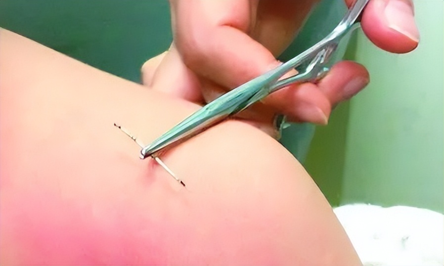 吓人！2岁女孩下身红肿一碰就疼，扒开裤子后，医生都心疼坏了