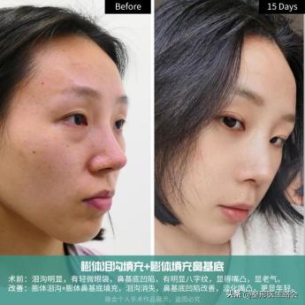 最让人显老的法令纹应该如何解决,法令纹和嘴角纹哪个更显老