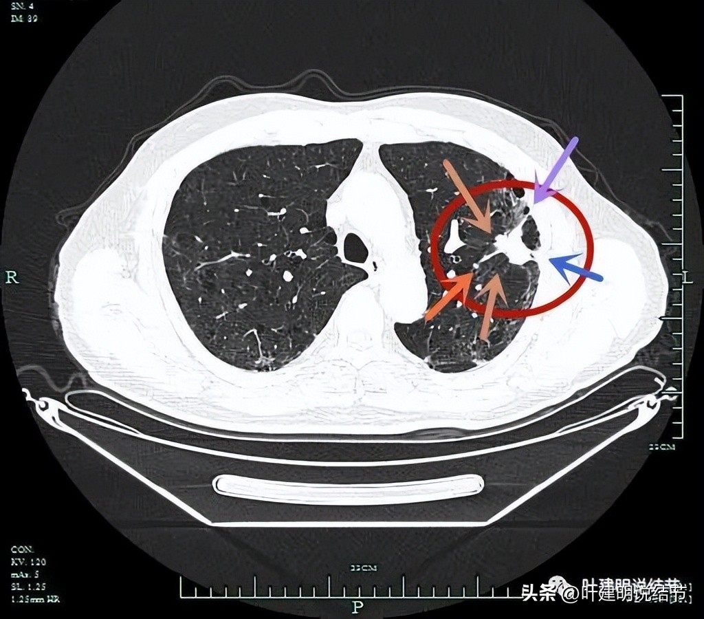 pet判断淋巴结转移,petct判断癌有没有转移准确吗