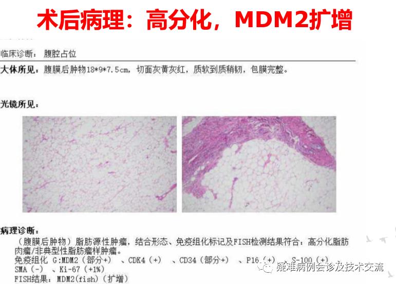 腹膜脂肪肉瘤治愈案例,原发性腹膜后脂肪肉瘤的综合治疗