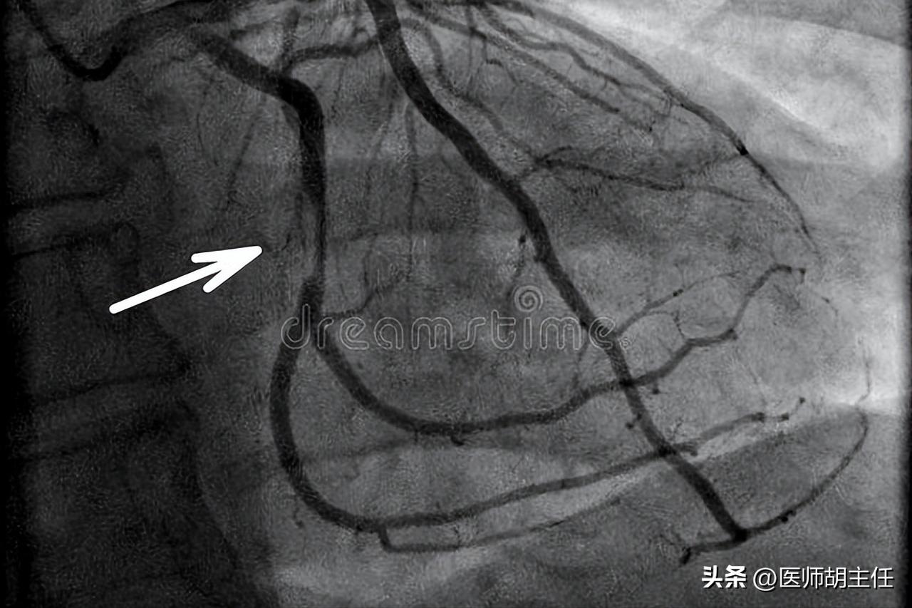 做冠状动脉造影对人体有副作用吗,做完冠脉造影后血管会变脆吗
