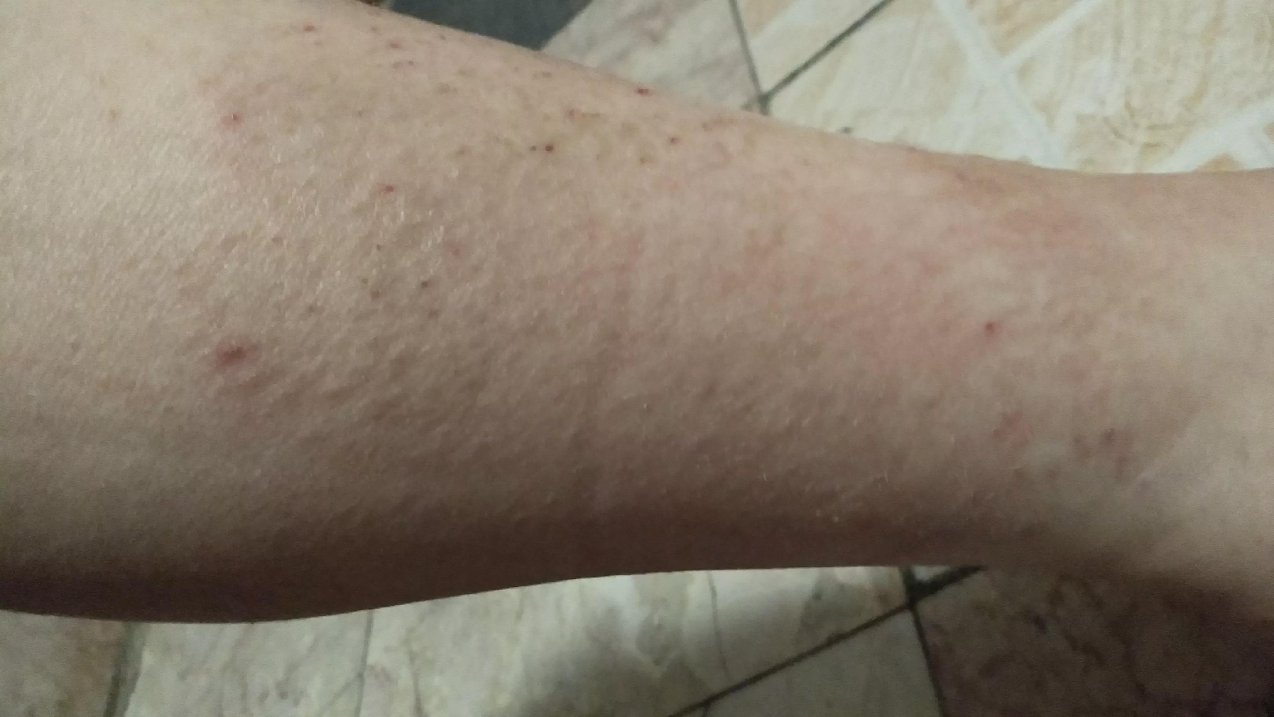 我多年的湿疹终于治好了,我湿疹怎么是一圈一圈的