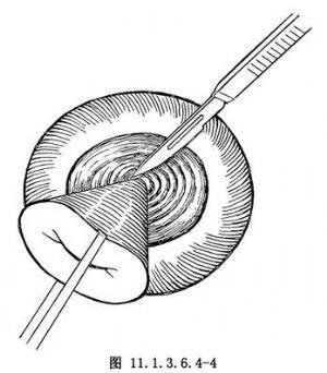 宫颈锥切手术操作,宫颈锥切术的全过程