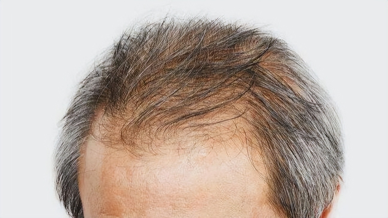 脱发为什么都是从头顶先秃,脱发为什么先从头顶脱