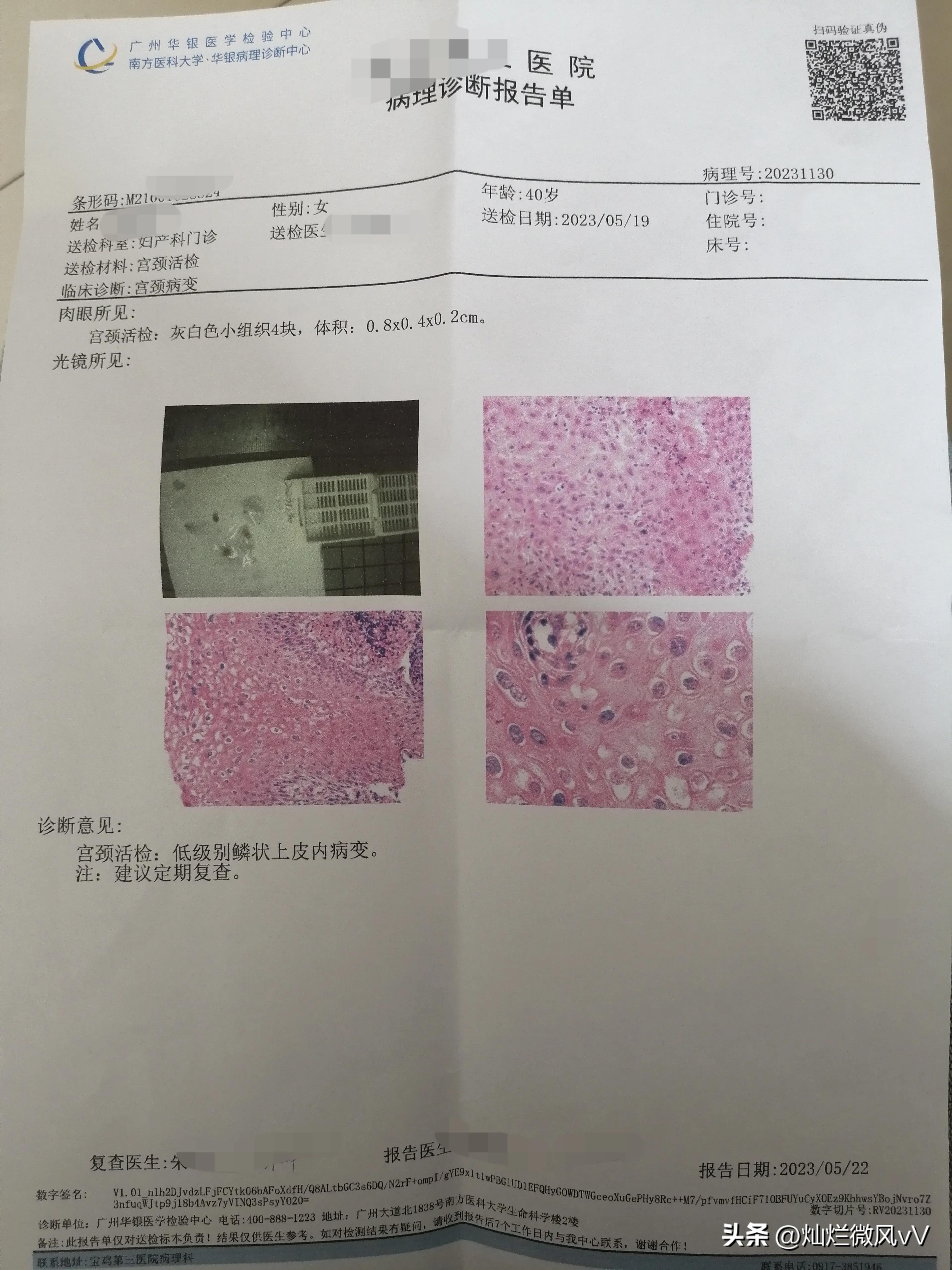 hpv16阳性宫颈活检鳞状上皮增生,宫颈活检低级别鳞状上皮病变cin1